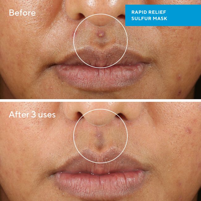 Rapid Relief Acne Sulfur Mask