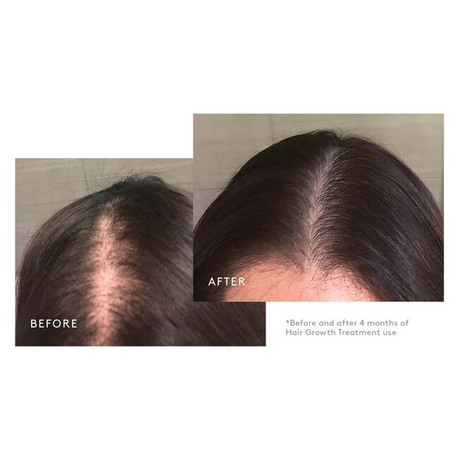 Flourish Hair Growth Treatment Set with Minoxidil Foam, 90-Day