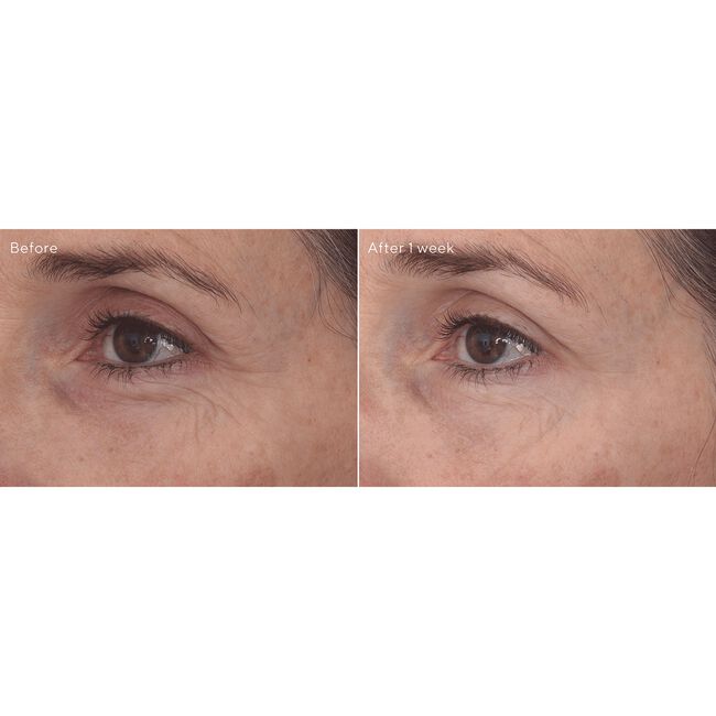 Retinal ReSculpt Eye Treatment